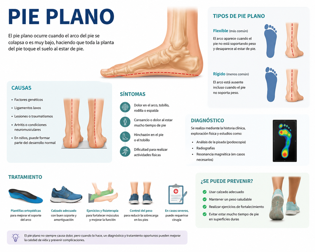 Ilustración anatómica del pie mostrando el colapso del arco plantar y el tendón tibial posterior en el pie plano