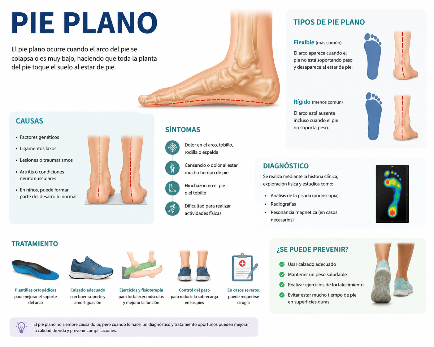 Ilustración anatómica del pie mostrando el colapso del arco plantar y el tendón tibial posterior en el pie plano